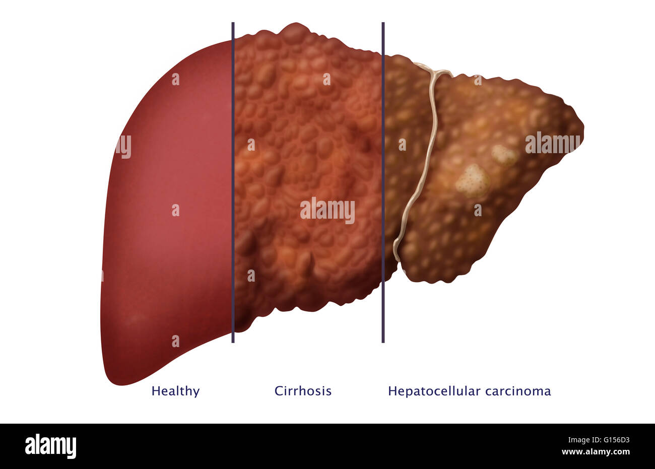 Illustration En Comparant L'aspect Santé Du Foie (à Gauche) Avec Son ...