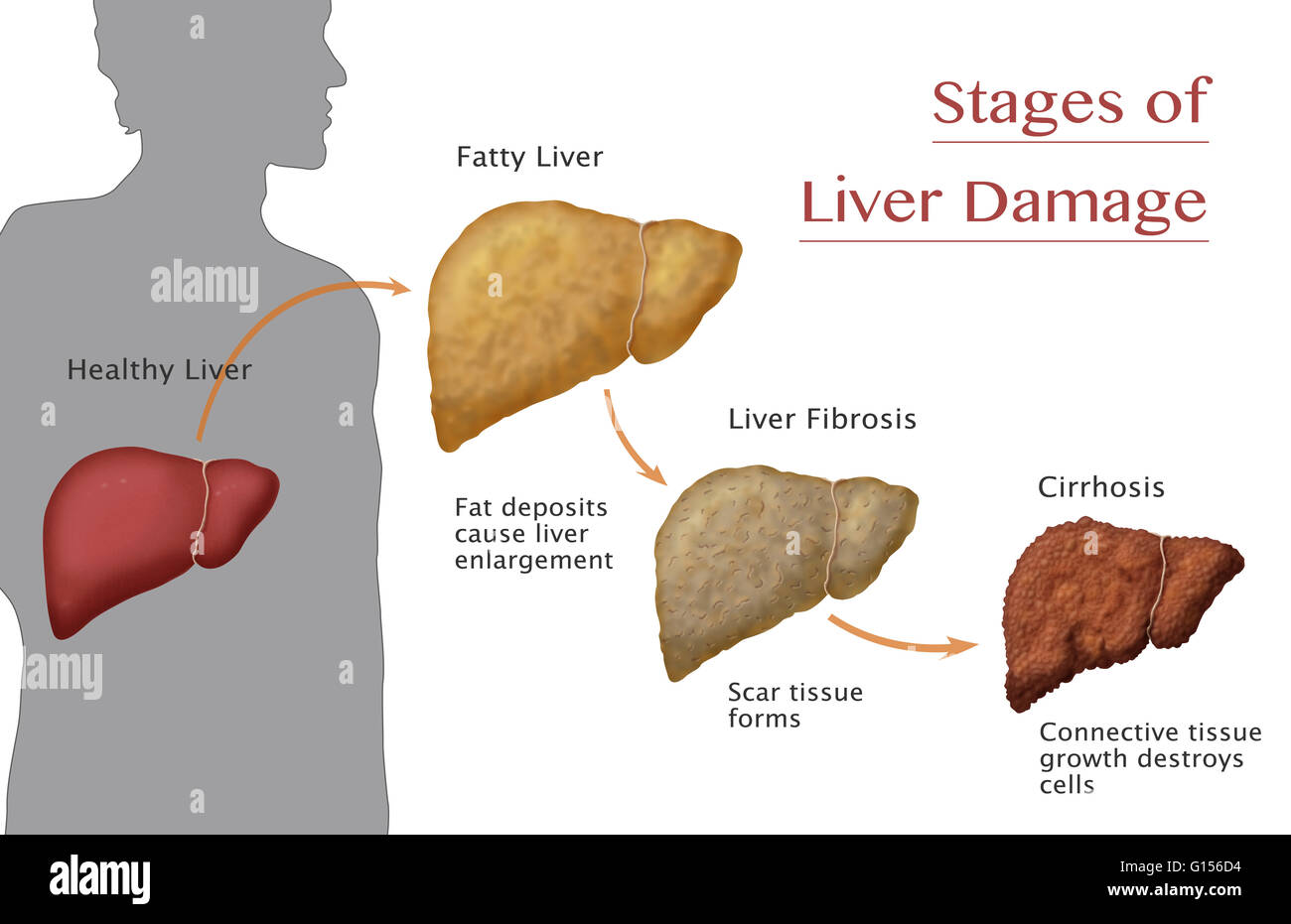 Étapes de l'atteinte hépatique. À partir de la santé du foie (à gauche), les dépôts de graisse cause hépatomégalie (stéatose hépatique ou d'une maladie du foie gras), les formulaires et plus les cellules du foie se produit (fibrose), enfin des tissus cicatriciels rend le foie dur et impossible Banque D'Images