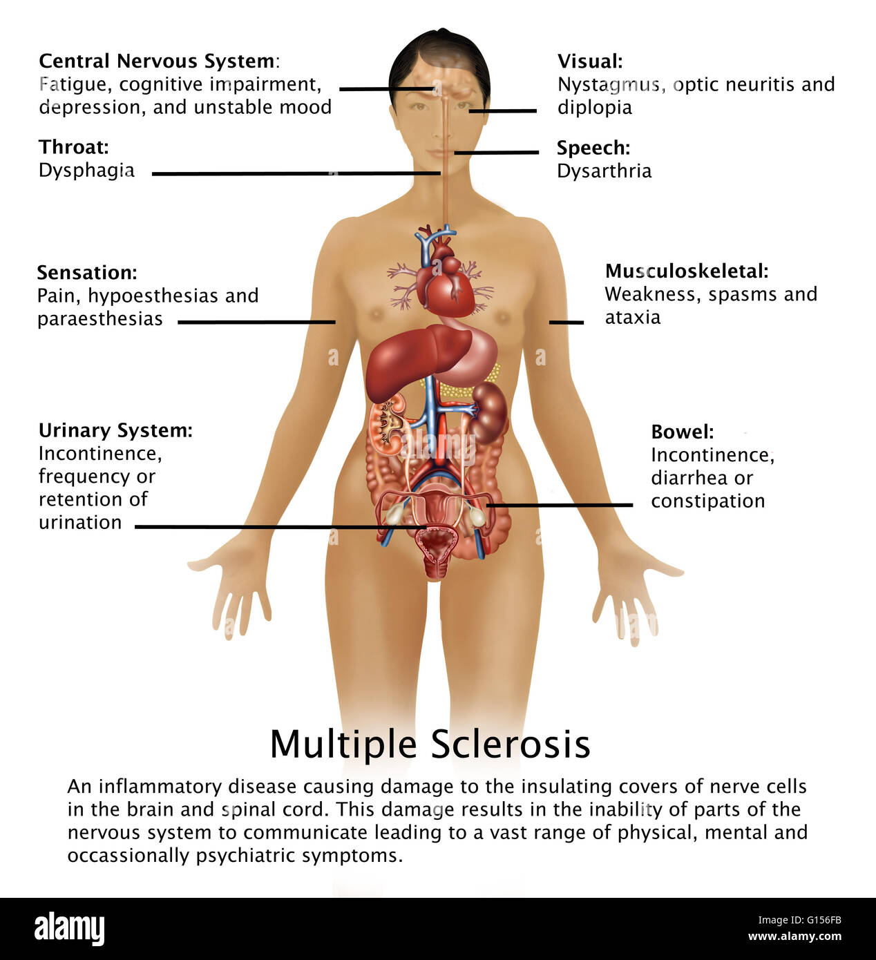Schéma montrant les symptômes de la sclérose en plaques et leur emplacement  dans le corps humain. La sclérose en plaques est une maladie inflammatoire  causant des dommages à l'isolant couvre des cellules