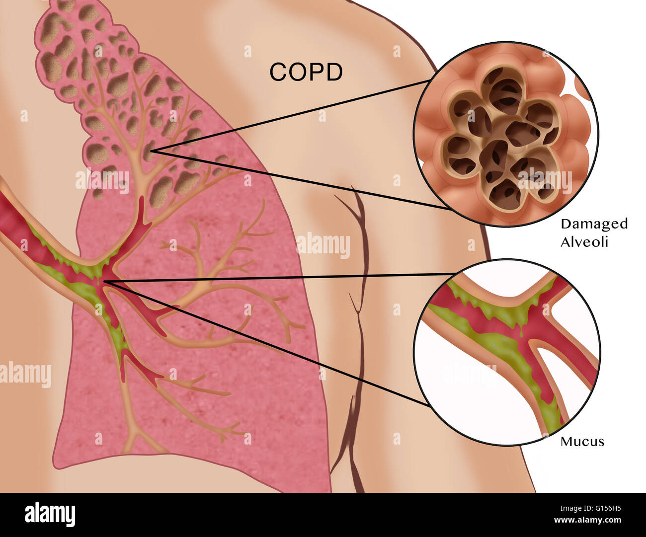 Illustration montrant certains des symptômes de maladie pulmonaire obstructive chronique (MPOC) : alvéoles endommagées (emphysème) et enflammée, mucus-bronches obstruées (bronchite). Banque D'Images
