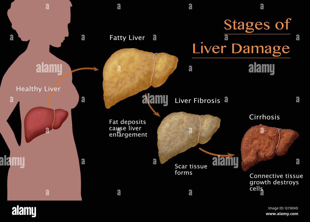 Étapes de l'atteinte hépatique due à l'alcoolisme. L'alcool compromet la première foie, causant d'importants dépôts de graisse à l'élaboration et l'élargissement de la stéatose hépatique (foie) ; si cette avance, les tissus cicatriciels et de formes plus graves surviennent des cellules du foie (fibrose) ; fina Banque D'Images