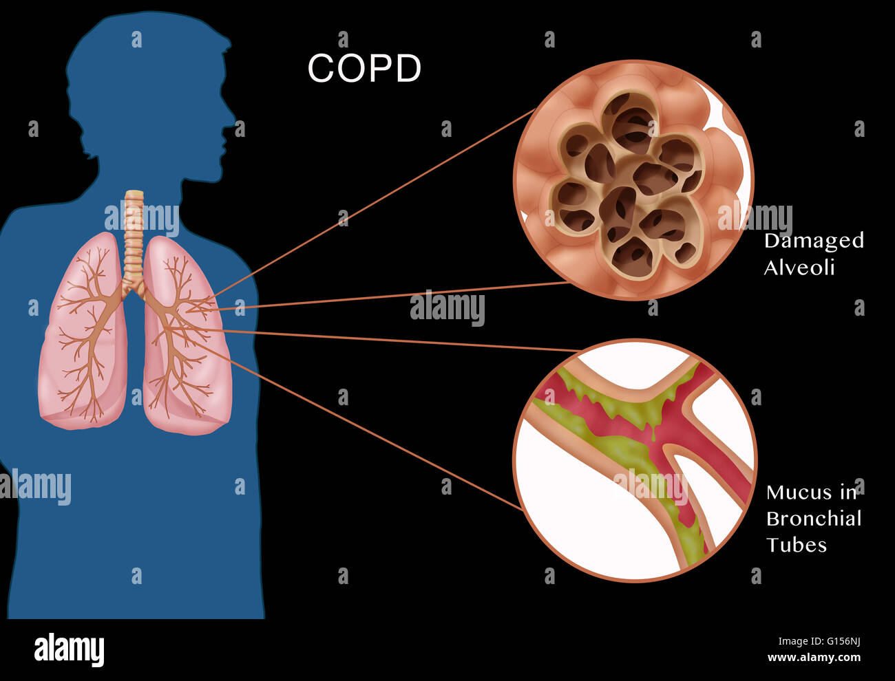 Illustration de la bronchopneumopathie chronique obstructive (BPCO ...