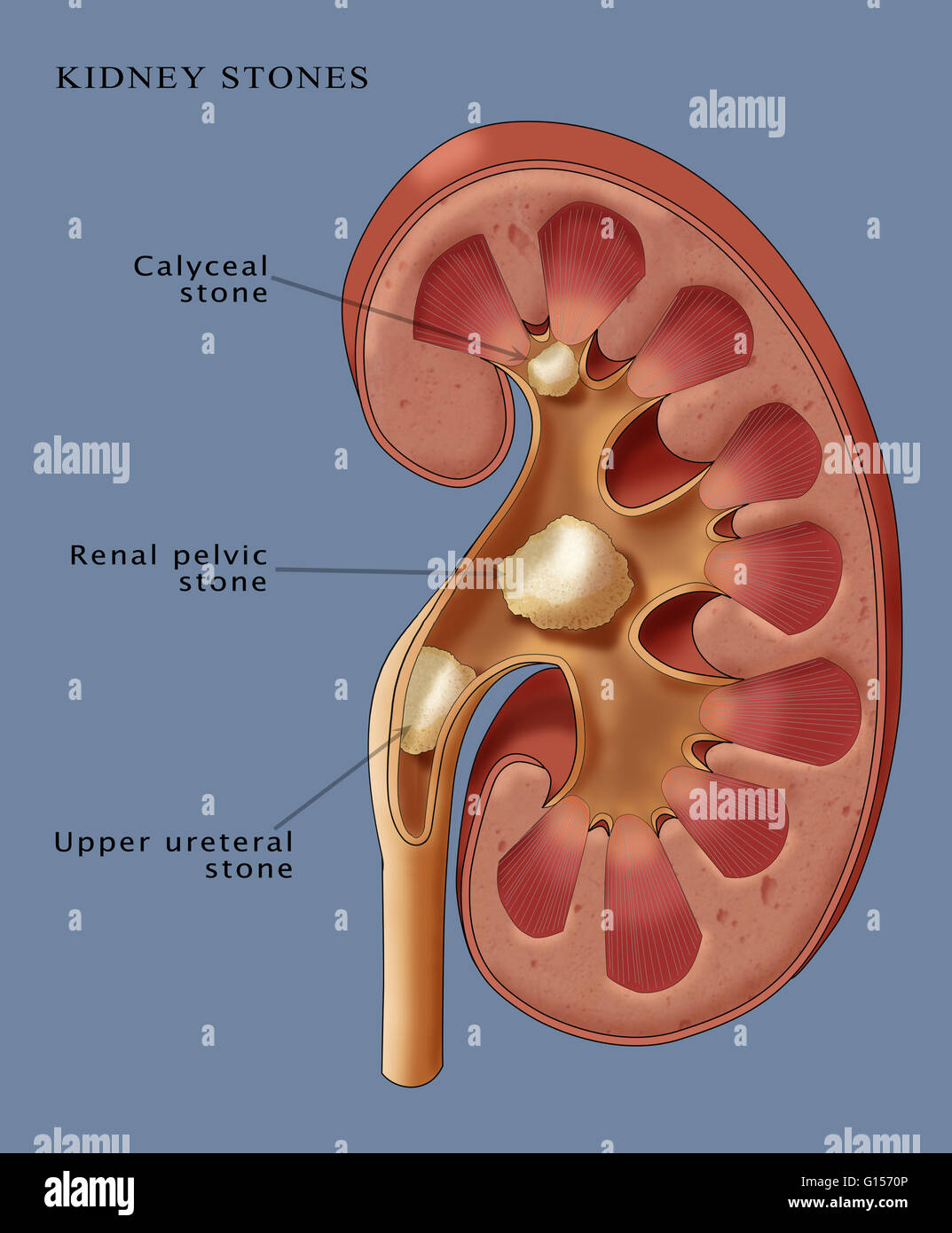Illustration montrant trois types de calculs rénaux : Calyceal pierre  (haut), Pierre pelvienne rénale (milieu), la région de Calcul urétéral (en  bas). Pierres de rein sont formés lorsque les sels minéraux calcium,