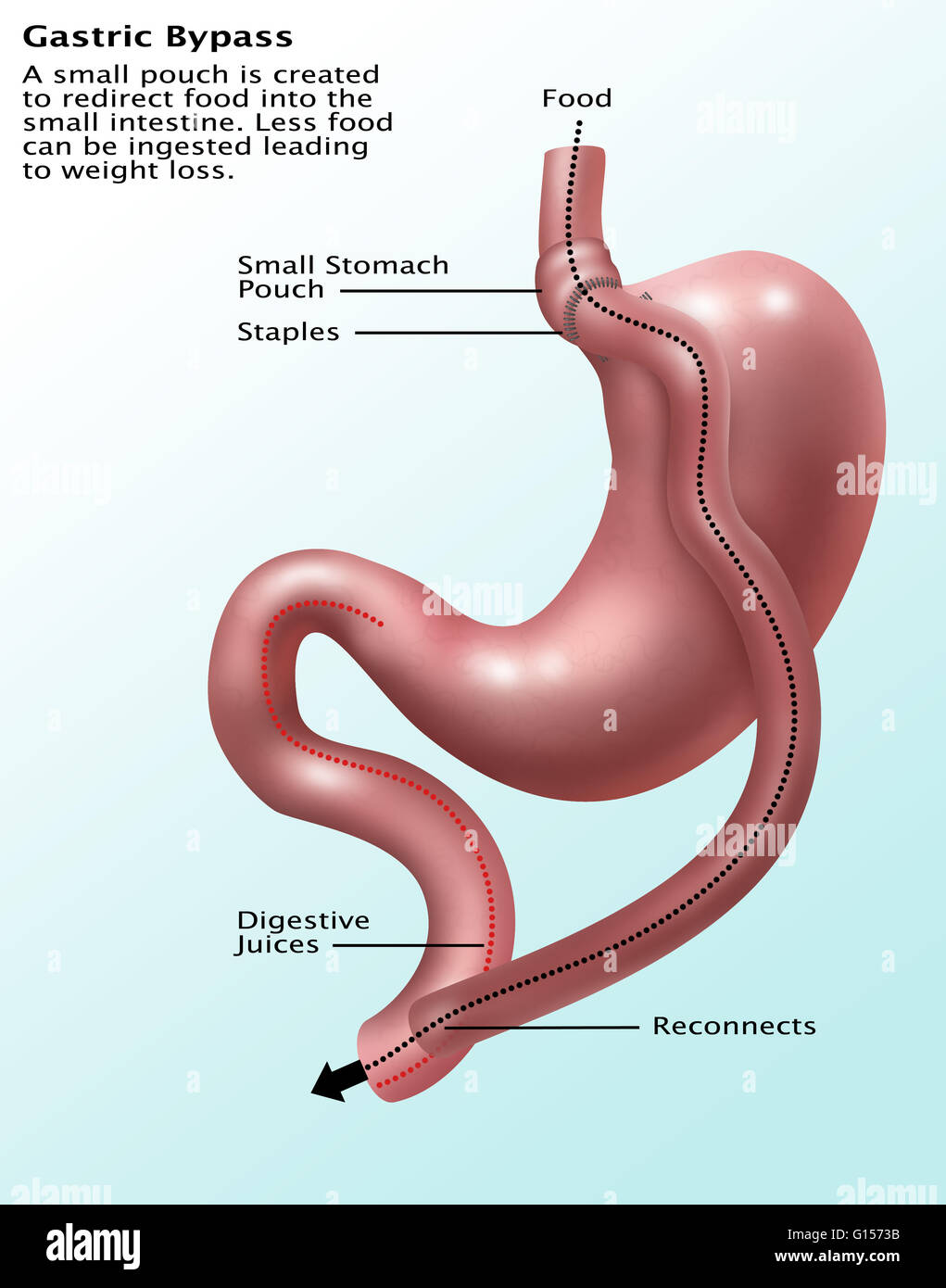 Bypass gastrique datant