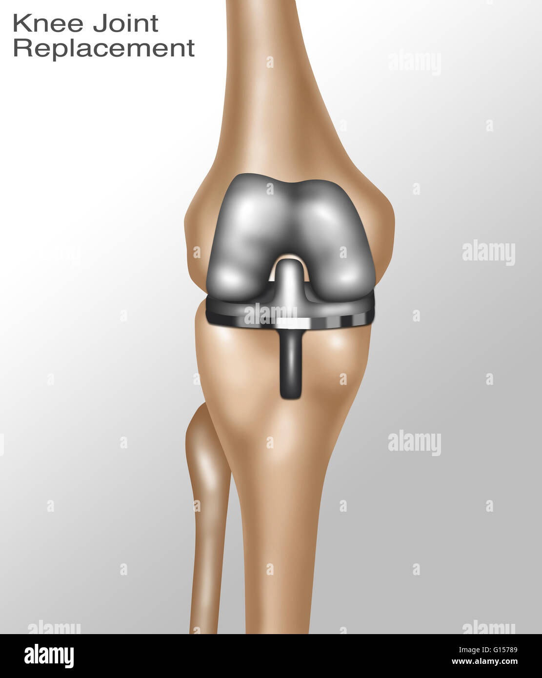 Illustration d'un genou montrant la surface du métal et roulement en plastique. Banque D'Images