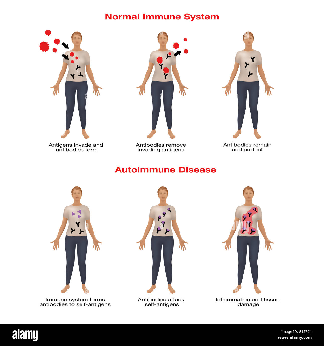 Maladie auto immune Banque de photographies et d’images à haute