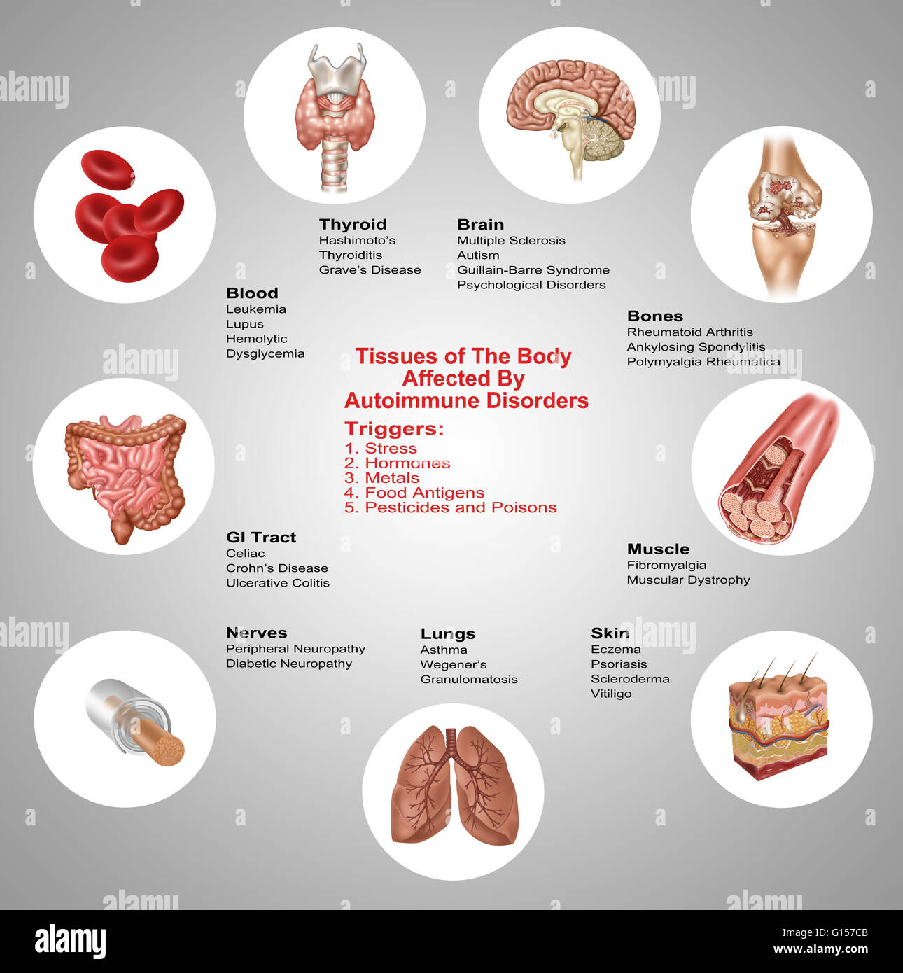 Les maladies auto-immunes peuvent être déclenchés par le texte suivant : le stress, les hormones, le métal, les antigènes alimentaires, pesticides et des poisons. Ils peuvent avoir de nombreux effets sur les tissus du corps comme le cerveau, les os, les muscles, la peau, les poumons, les nerfs, le tube digestif, le sang et Banque D'Images