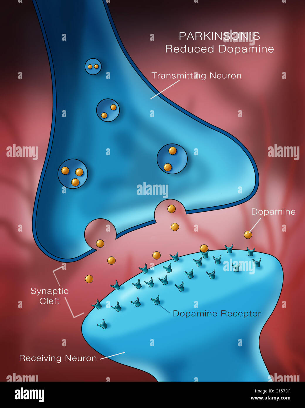 Illustration de l'étiquette de faibles niveaux d'un neurotransmetteur, la dopamine dans un neurone affecté par la maladie de Parkinson. Banque D'Images