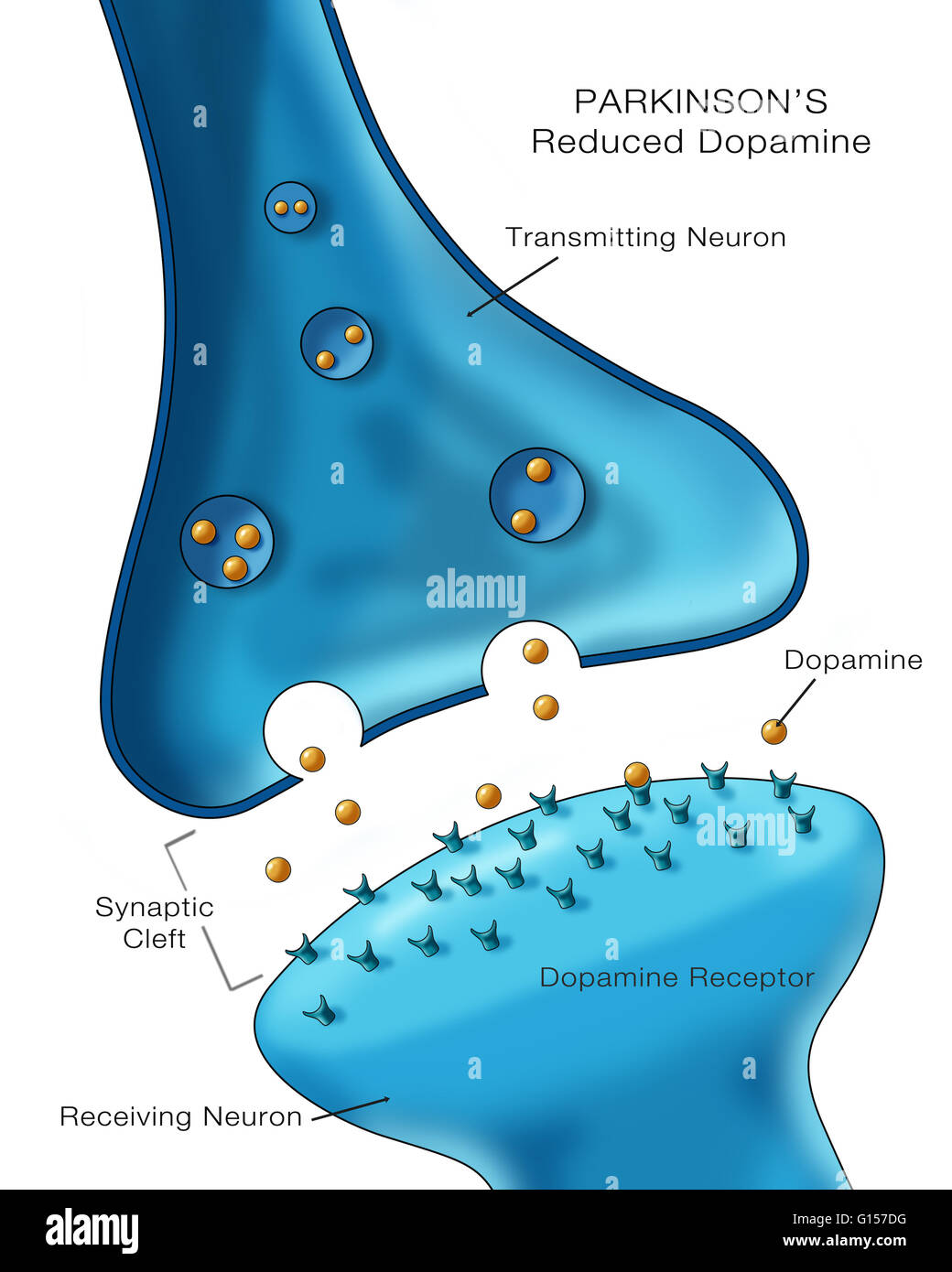 Illustration de l'étiquette de faibles niveaux d'un neurotransmetteur, la dopamine dans un neurone affecté par la maladie de Parkinson. Banque D'Images