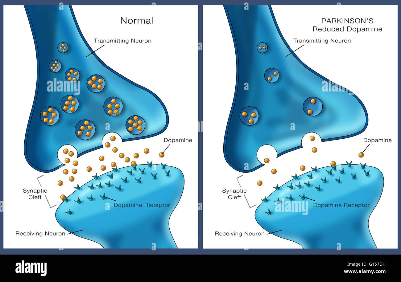 Illustration de l'étiquette de faibles niveaux d'un neurotransmetteur, la dopamine dans un neurone affecté par la maladie de Parkinson (à droite) et des niveaux normaux sur la gauche. Banque D'Images