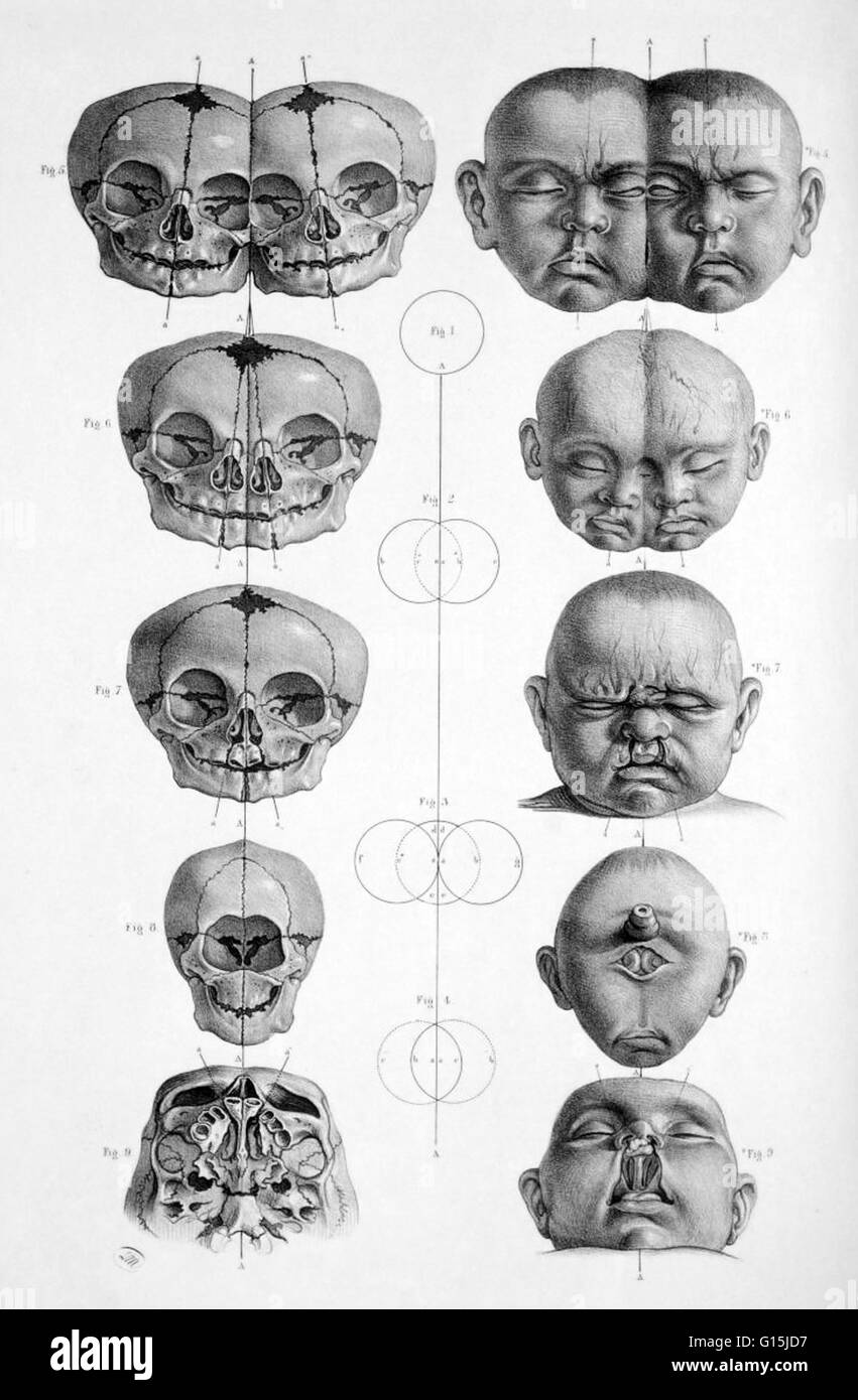 'Tête et crâne d'un des bébés ; jumeaux siamois, fente labiale bilatérale et l'holoprosencéphalie,' de Joseph Maclise Anatomie chirurgicale du livre, publié à Londres en 1856. Banque D'Images