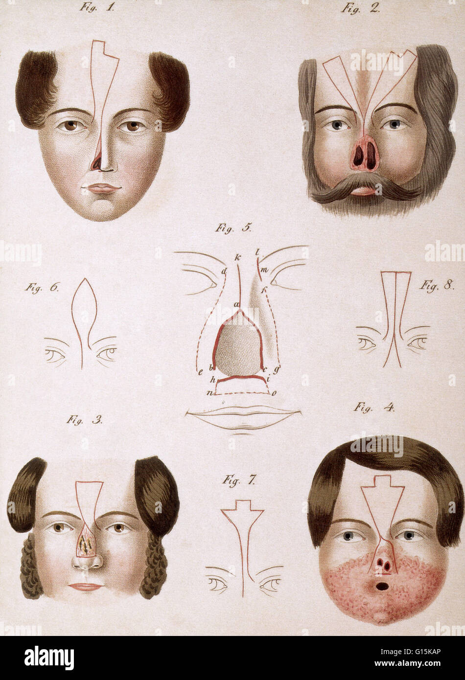 L'illustration à la reconstruction du nez d'un texte médical 1815. Banque D'Images