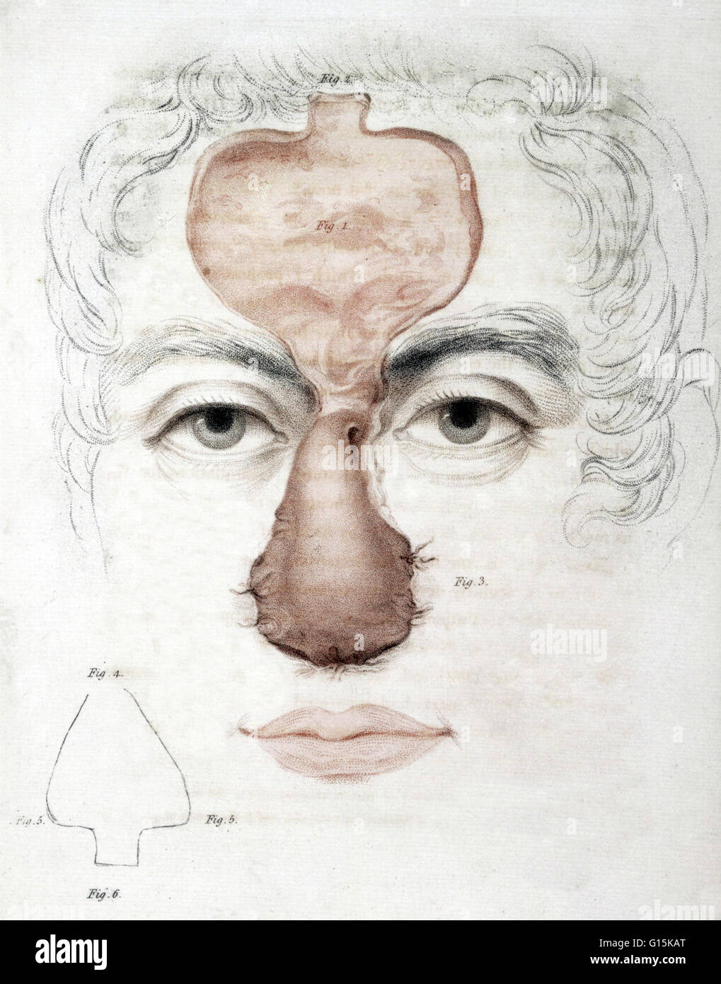 L'illustration à la reconstruction du nez d'un texte médical 1815. Banque D'Images