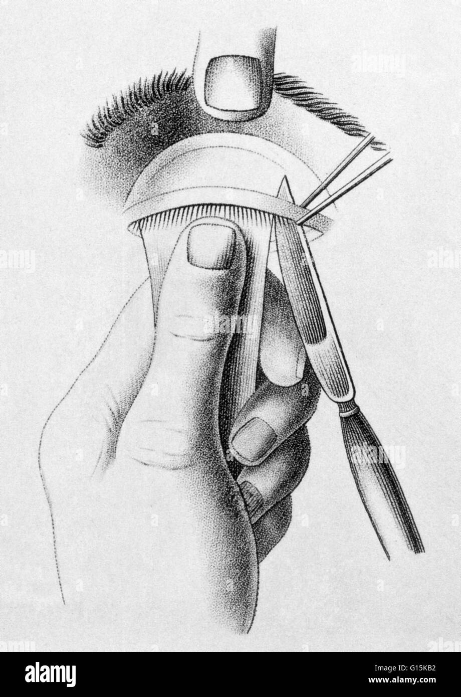 Illustration de la procédure chirurgicale pour corriger un paresseux de la paupière supérieure (ptosis), ch. 1830. Banque D'Images