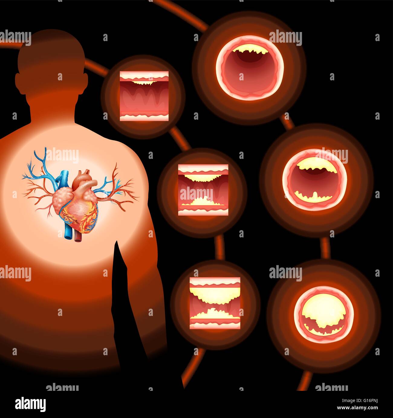 Cholestérol coeur dans le corps humain illustration Image Vectorielle Stock Alamy