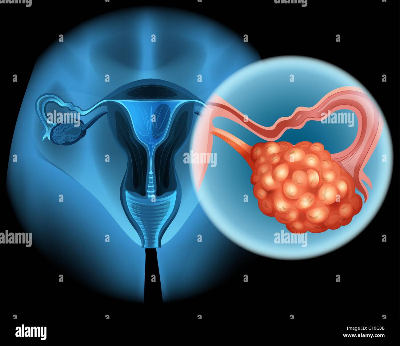 Cancer de l'ovaire dans les droits de l'illustration Illustration de Vecteur