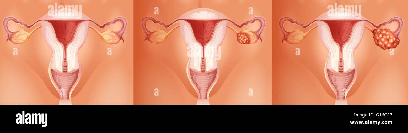 Trois stades de cancer de l'ovaire illustration Illustration de Vecteur