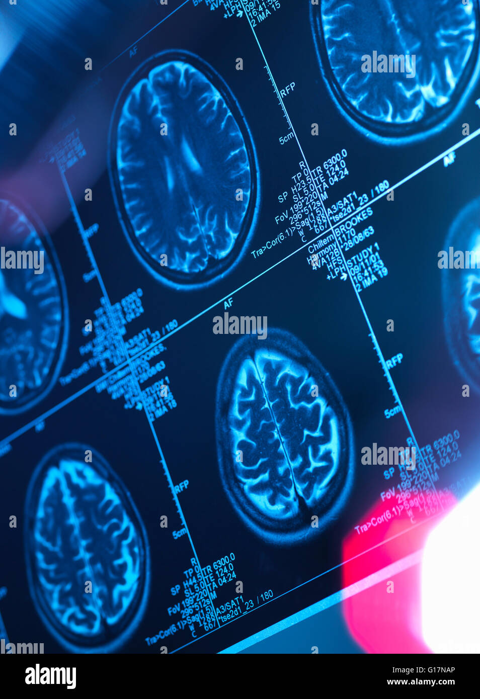 Scan du cerveau humain dans une clinique de neurologie Banque D'Images