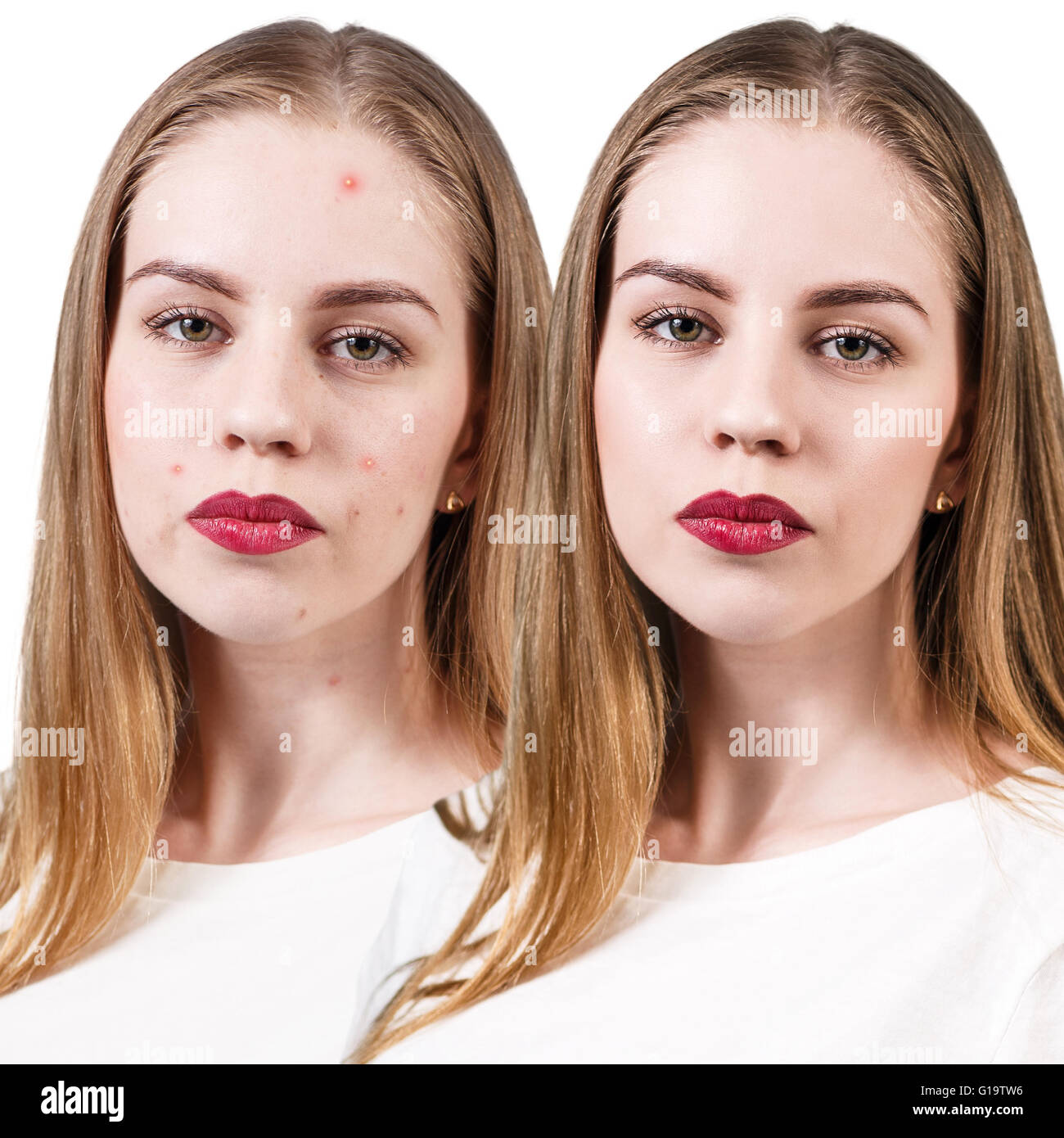 Femme avec des problèmes de peau sur son visage avant et après traitement, isolated on white Banque D'Images