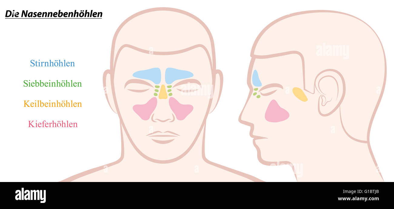 Sinus paranasaux sur un visage masculin en différentes couleurs - TEXTE ALLEMAND ! Banque D'Images