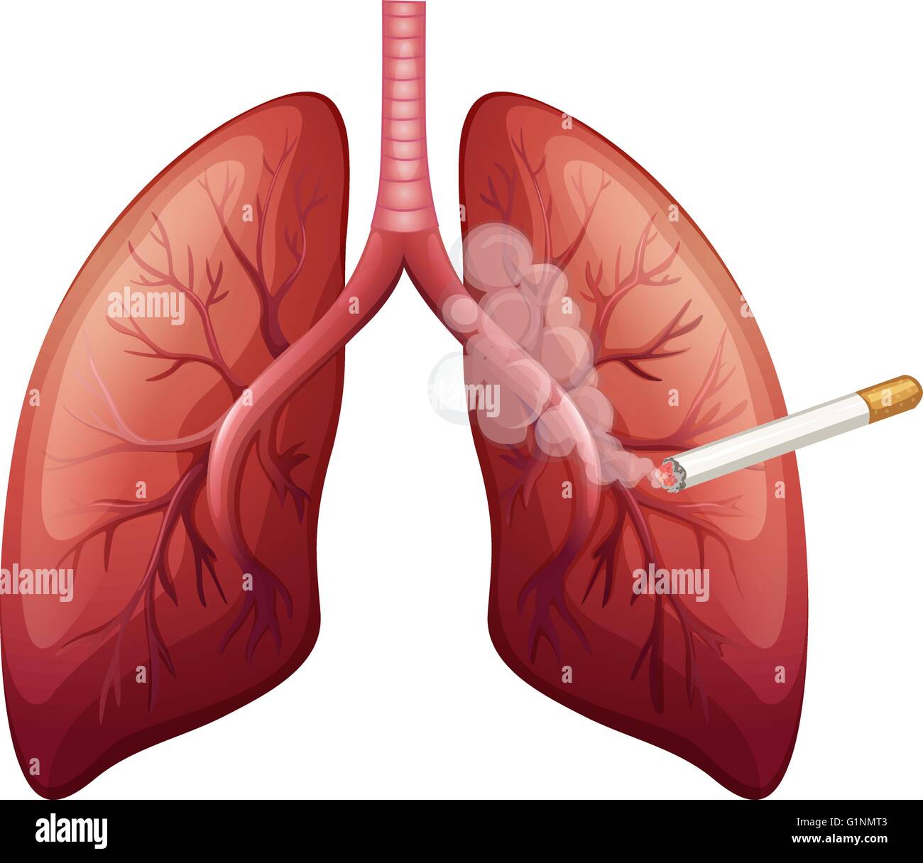 Le cancer du poumon avec illustration de fumée Illustration de Vecteur