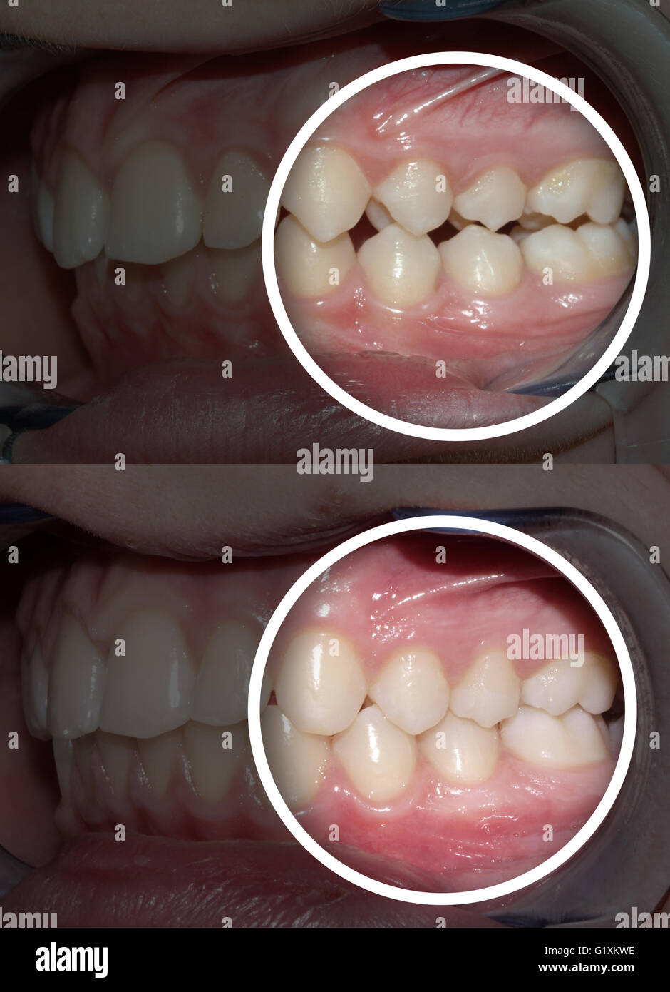 Soins dentaires Orthodontie Traitement de la malocclusion : avant et après Banque D'Images