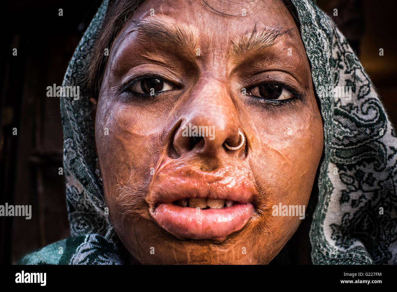Cicatrices visage d'une femme à New Delhi, Inde Photo Stock - Alamy