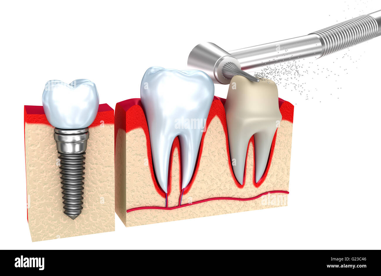 Couronne dentaire implant , et les dents , image 3D . Banque D'Images