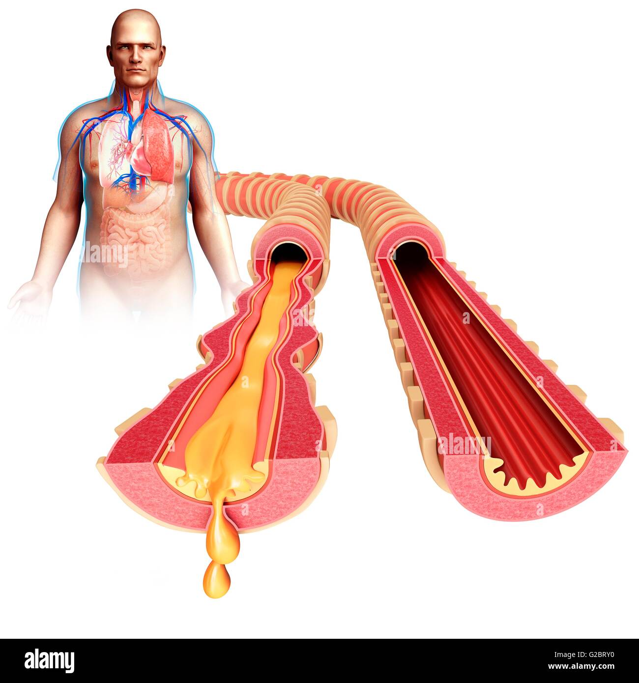 Bronches infectées d'un enfant, de l'illustration. Banque D'Images