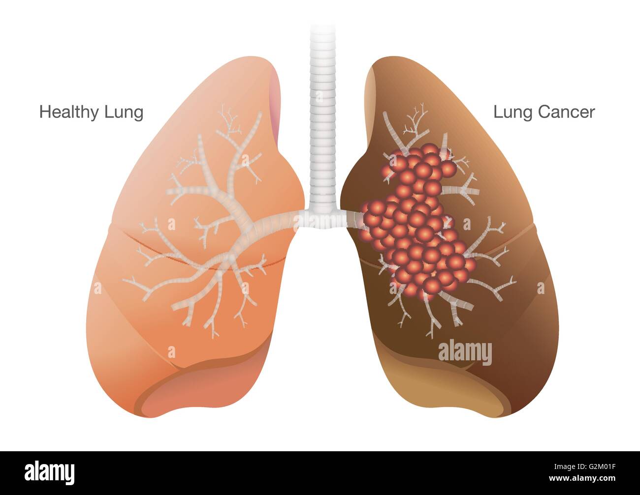 Comparaison entre le cancer du poumon et de poumons en santé Illustration de Vecteur