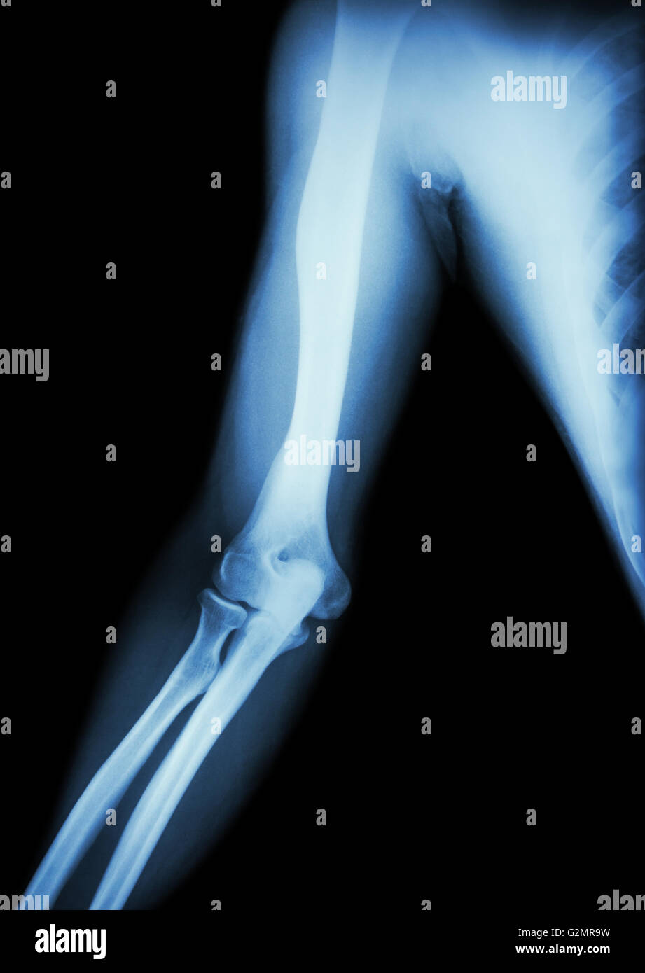 Film x-ray de la normale , bras coude et de l'avant-bras ( fond noir ) Banque D'Images