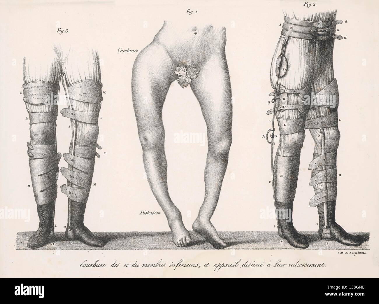 Jambes et Bow leur traitement par l'appareil destiné à les redresser Date : 1827 Banque D'Images