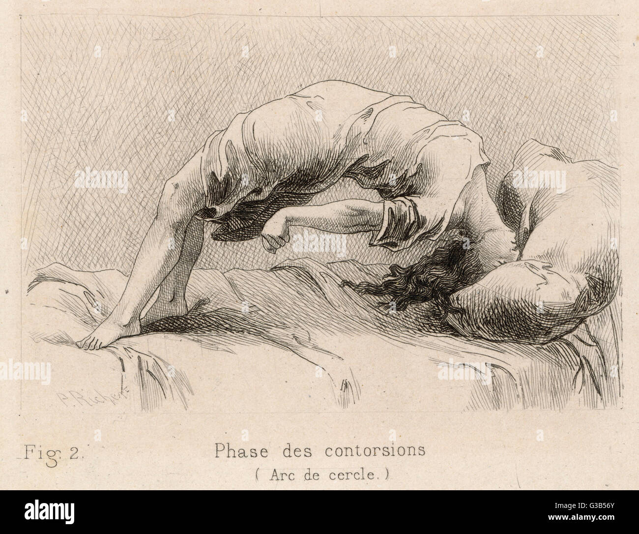 Malade mentale à la Salpetriere, en passant par la phase de contorsions Date : 1881 Banque D'Images