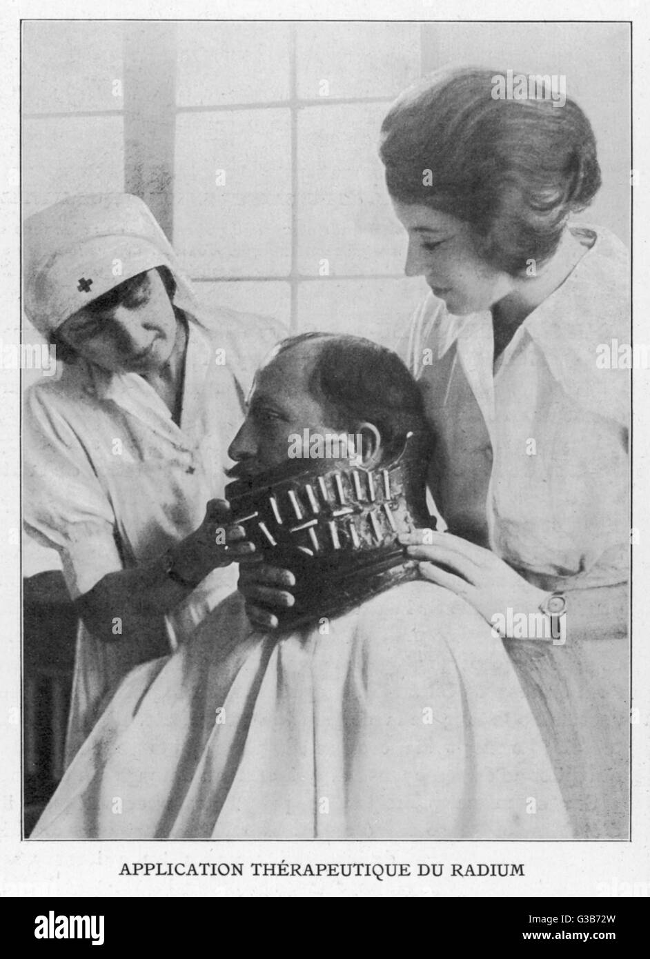 Un possible traitement contre le cancer : tubes contenant de petites sommeille de radium sont placés à proximité de la partie touchée... Date : 1926 Banque D'Images
