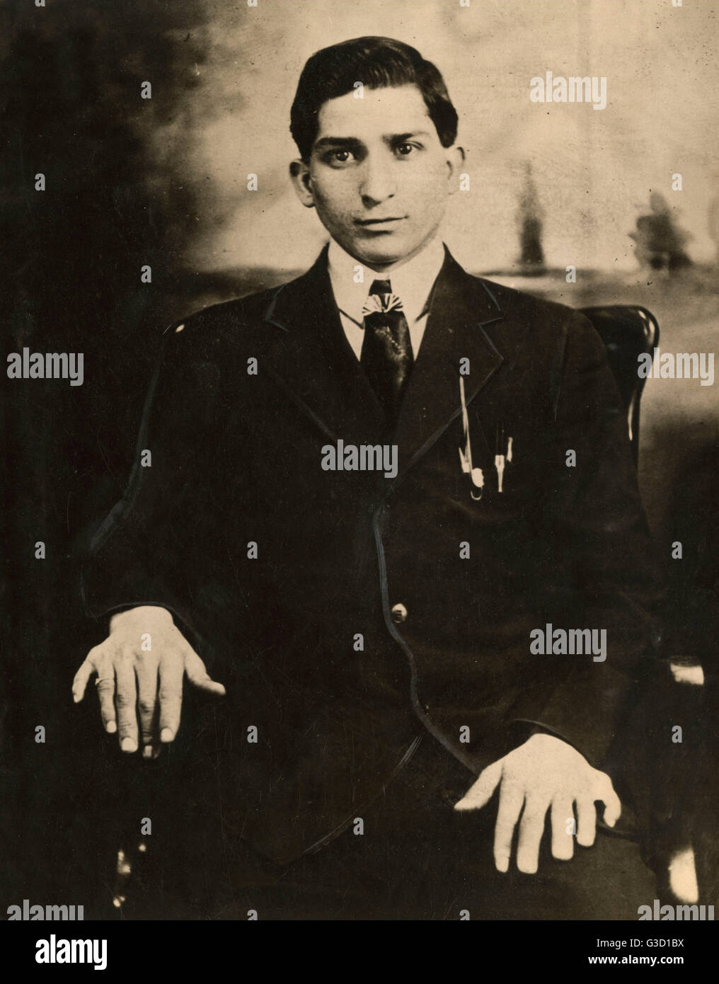Polydactylie - un homme à six doigts de l'État de New York, États-Unis Banque D'Images