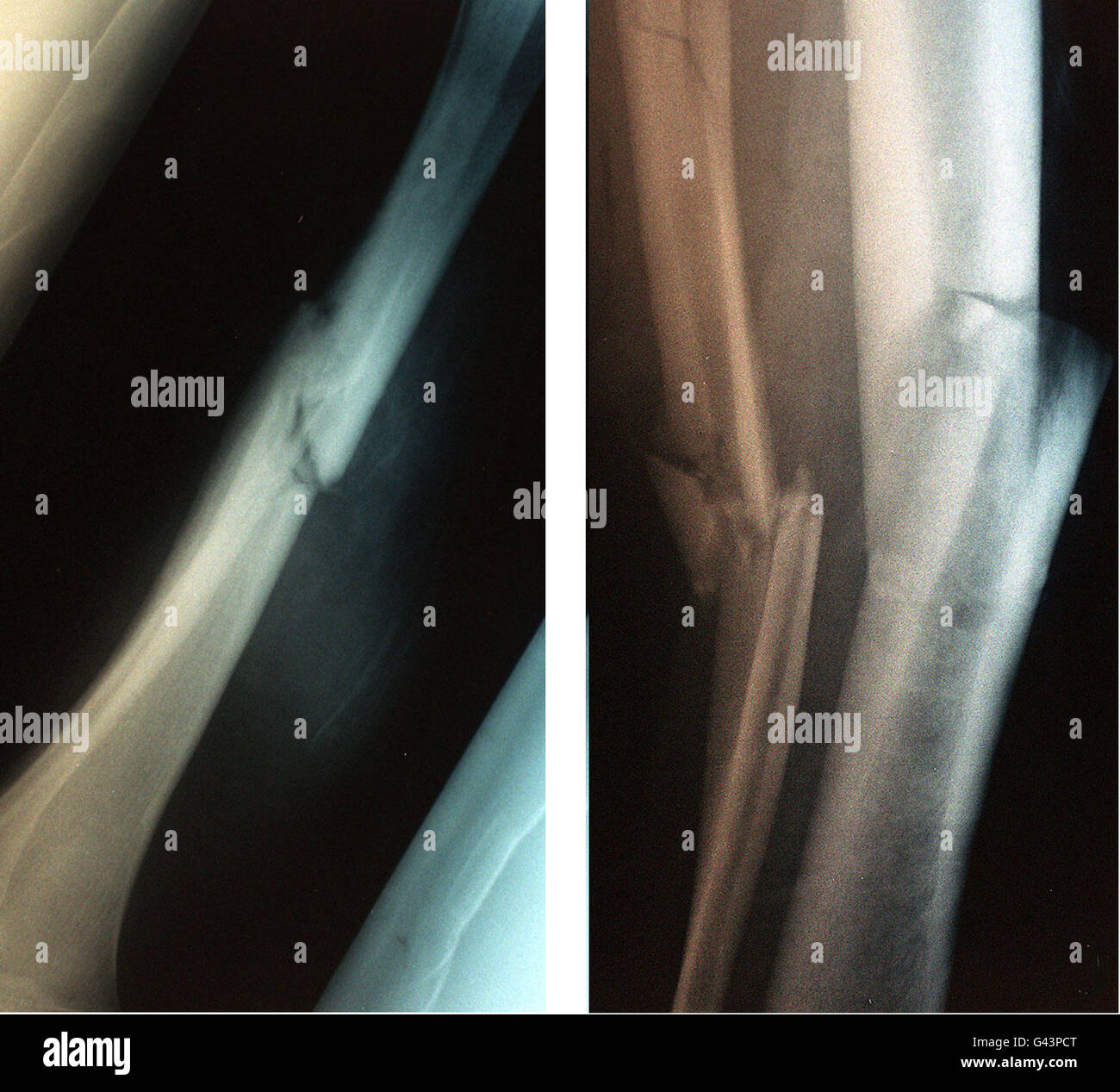 Des images radiographiques prises de deux angles différents de la rupture dans la jambe droite du joueur de Coventry City Dave Busst après la blessure qu'il a subi pendant le match contre Manchester United. Banque D'Images