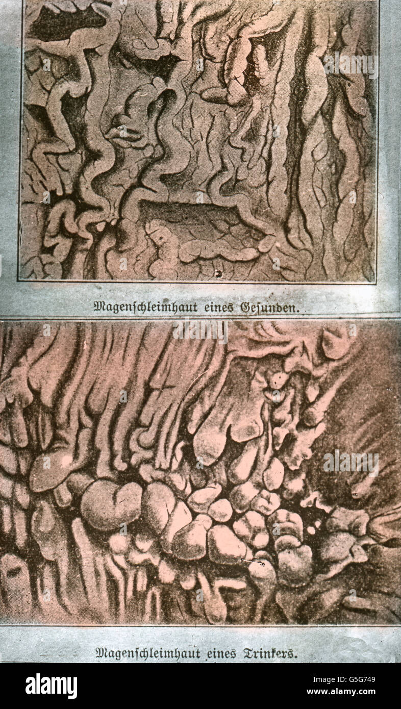 Magenschleimhaut gesund und Schmitt. La paroi de l'estomac et l — free download