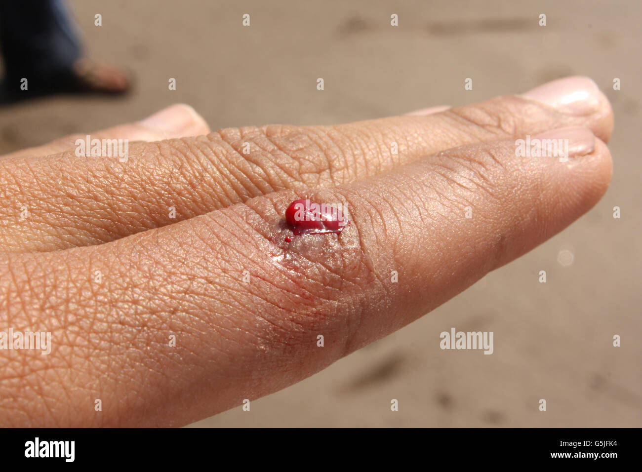 La coagulation du sang sur la plaie sur un doigt humain. Banque D'Images