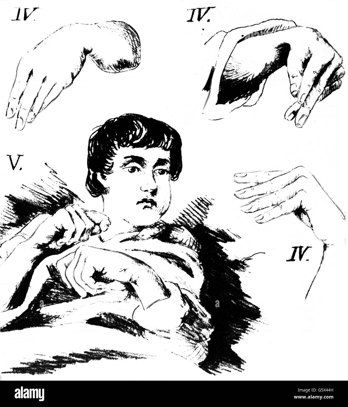 Médicaments, poison, symptômes d'intoxication avec l'ergot sur la main, dessin, hors de: Theodor Otto Heustinger, 'Studien ueber den Ergotismus', Marburg, 1856, droits additionnels-Clearences-non disponible Banque D'Images Médicaments, poison, symptômes d'intoxication avec l'ergot sur la main, dessin, hors de: Theodor Otto Heustinger, 'Studien ueber den Ergotismus', Marburg, 1856, droits additionnels-Clearences-non disponible Banque D'Images
