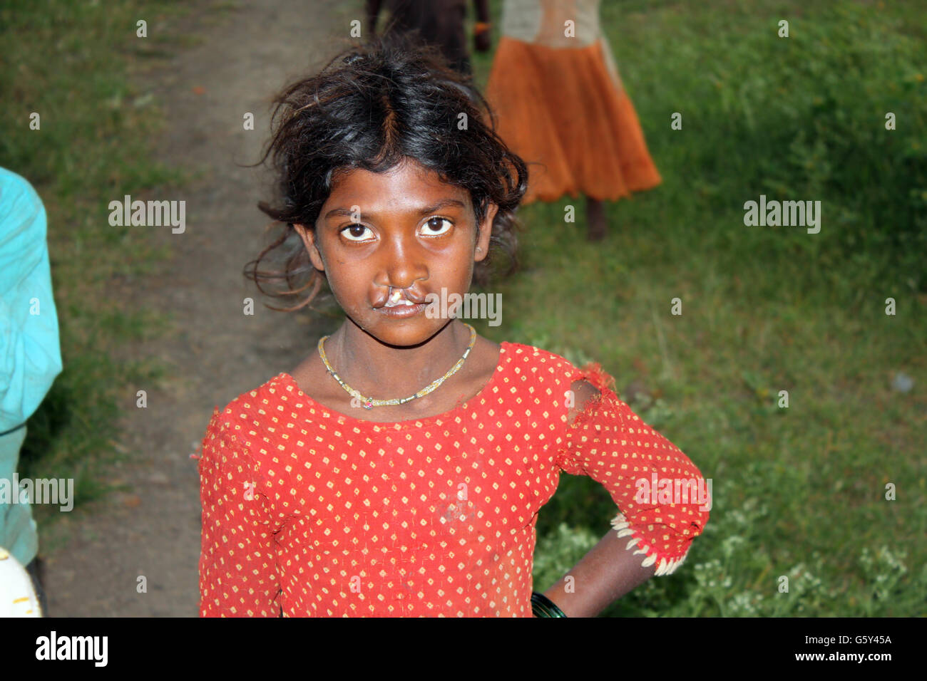 Un portrait d'une pauvre fille indienne avec une fente labiale et palatine problème. Banque D'Images