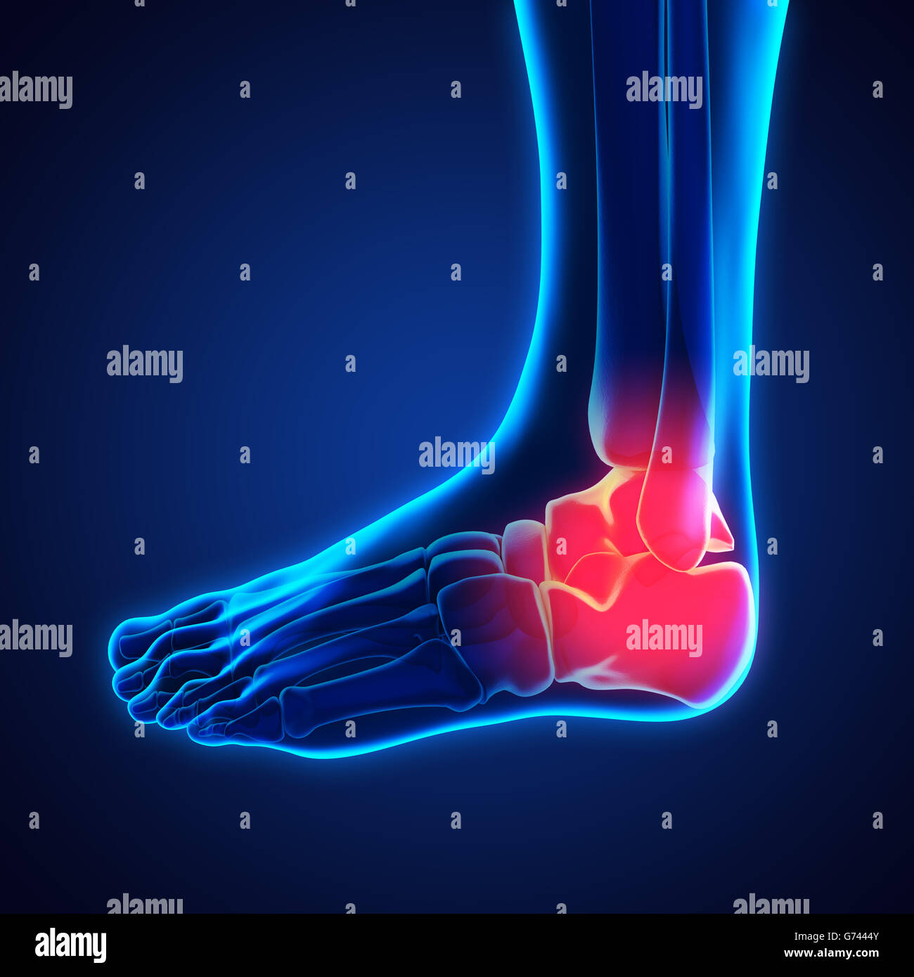 La cheville douloureuse illustration Banque D'Images