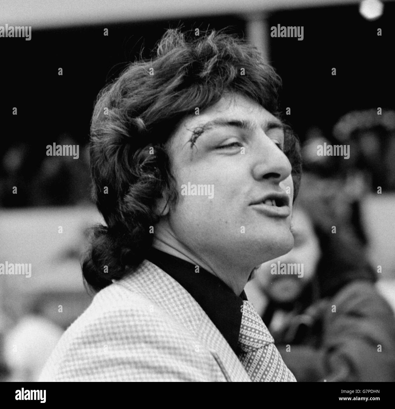Brian Talbot.Brian Talbot de la ville d'Ipswich, avec son œil coupé après la demi-finale de la coupe FA contre West Bromwich Albion. Banque D'Images