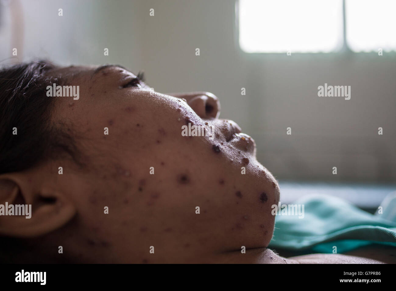 Une femme adulte admise à la Fundação de Medicina Tropical do Amazonas à Manaus, au Brésil, présente l’éruption de rougeole caractéristique – des taches maculopapulaires rouges qui commencent sur le visage et se propagent à travers le corps. Cette infection virale aéroportée hautement contagieuse souligne le besoin critique d'une couverture vaccinale solide et de mesures de santé publique renforcées dans la région amazonienne. Banque D'Images