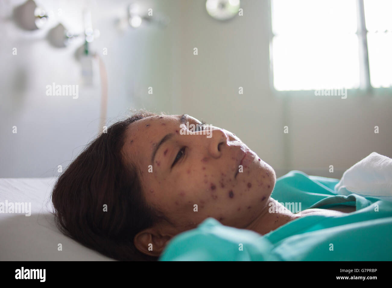 Une femme adulte admise à la Fundação de Medicina Tropical do Amazonas à Manaus, au Brésil, présente l’éruption de rougeole caractéristique – des taches maculopapulaires rouges qui commencent sur le visage et se propagent à travers le corps. Cette infection virale aéroportée hautement contagieuse souligne le besoin critique d'une couverture vaccinale solide et de mesures de santé publique renforcées dans la région amazonienne. Banque D'Images