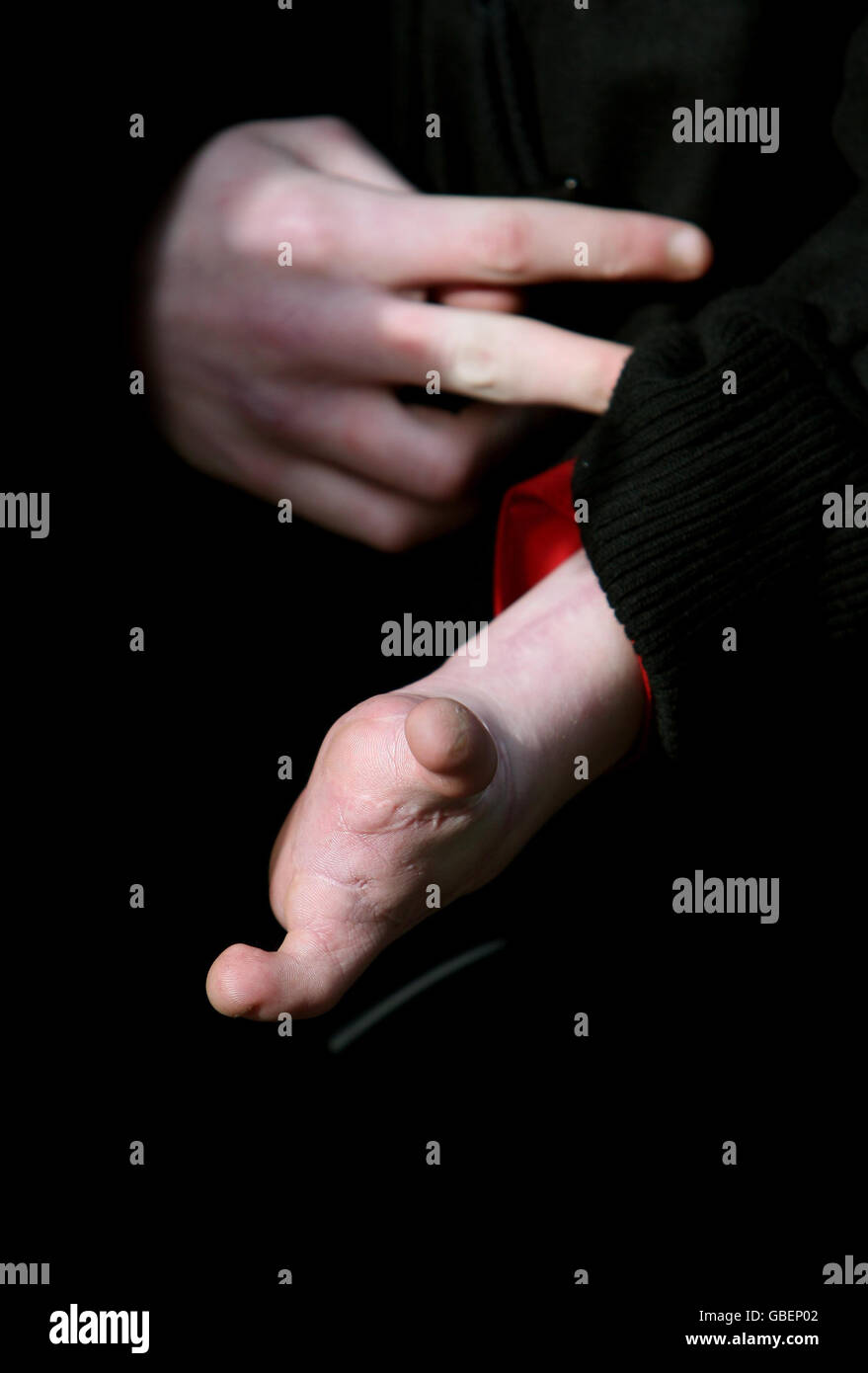 Les mains de Connor McIntyre, 12 ans, de Corby, sont vues à l'extérieur des cours royales de justice de Londres, où un groupe de familles intente une action en dommages-intérêts de plusieurs millions de livres contre Corby Borough Council. Banque D'Images