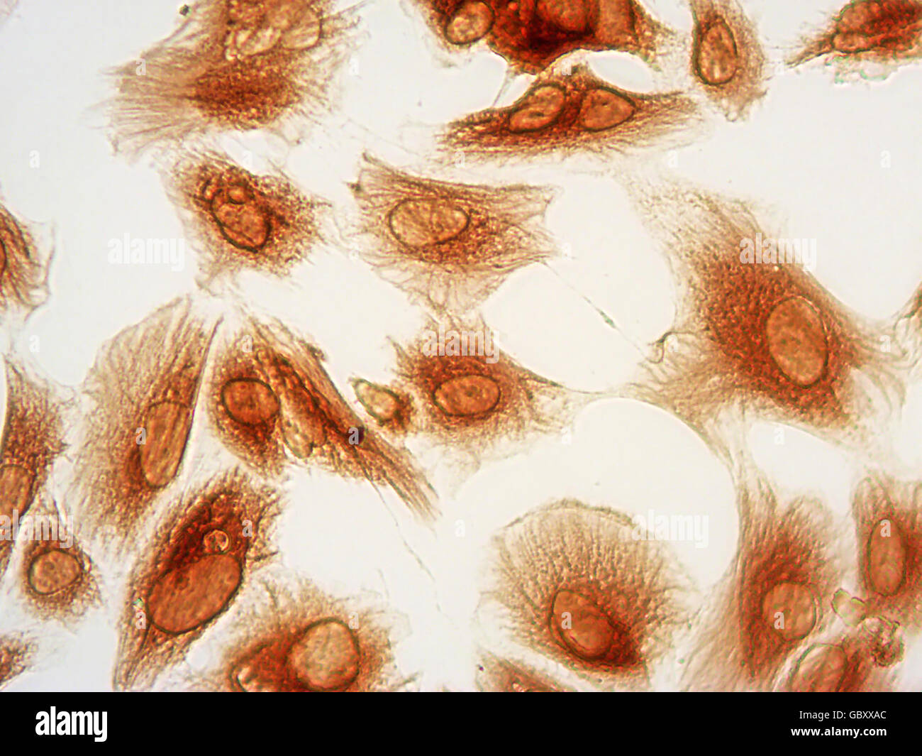 Photomicrographie de cellules stromales de l'endomètre humain tachées par immunocytochimie de protéine de la vimentine (marron), 40x. Banque D'Images