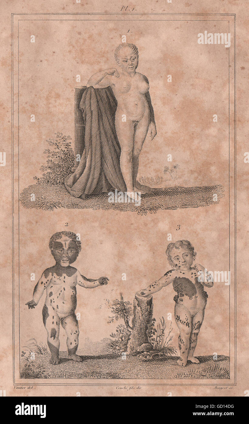La médecine : nanisme. Malformations génétiques. BUFFON, antique print 1837 Banque D'Images
