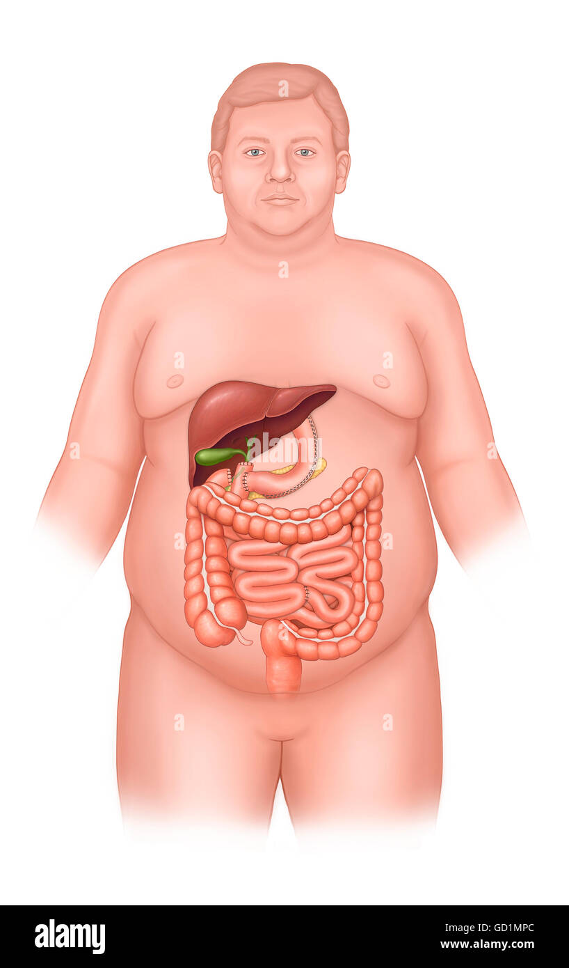 La chirurgie de dérivation pancréatique bilio post et des organes abdominaux Banque D'Images