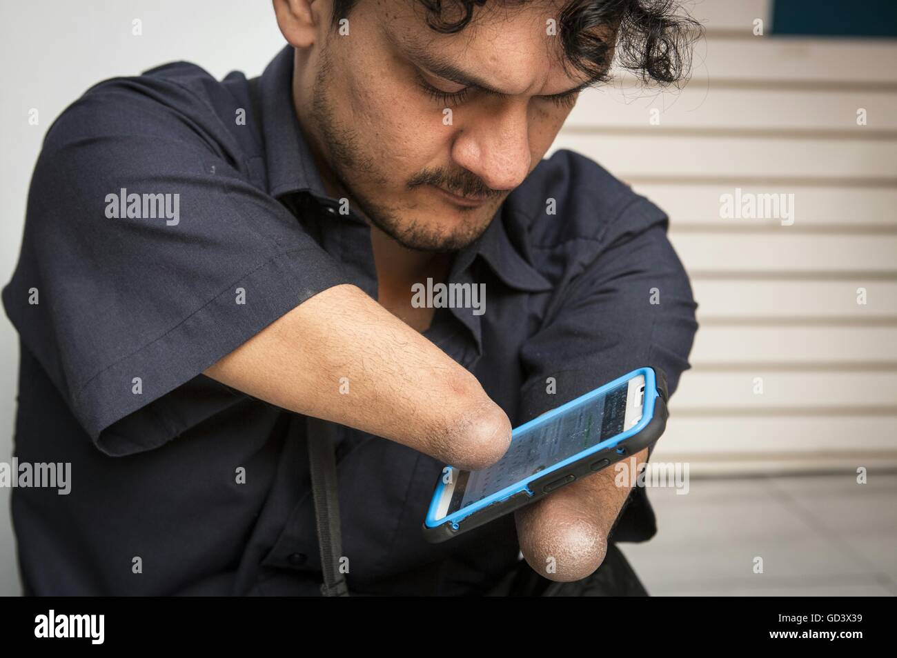 Congenital malformation Banque de photographies et d’images à haute