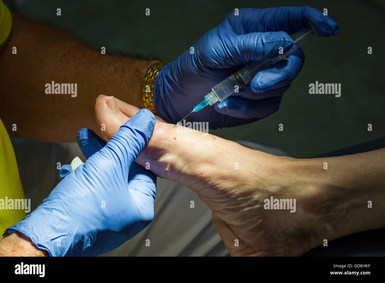 Chirurgie du pied Banque D'Images
